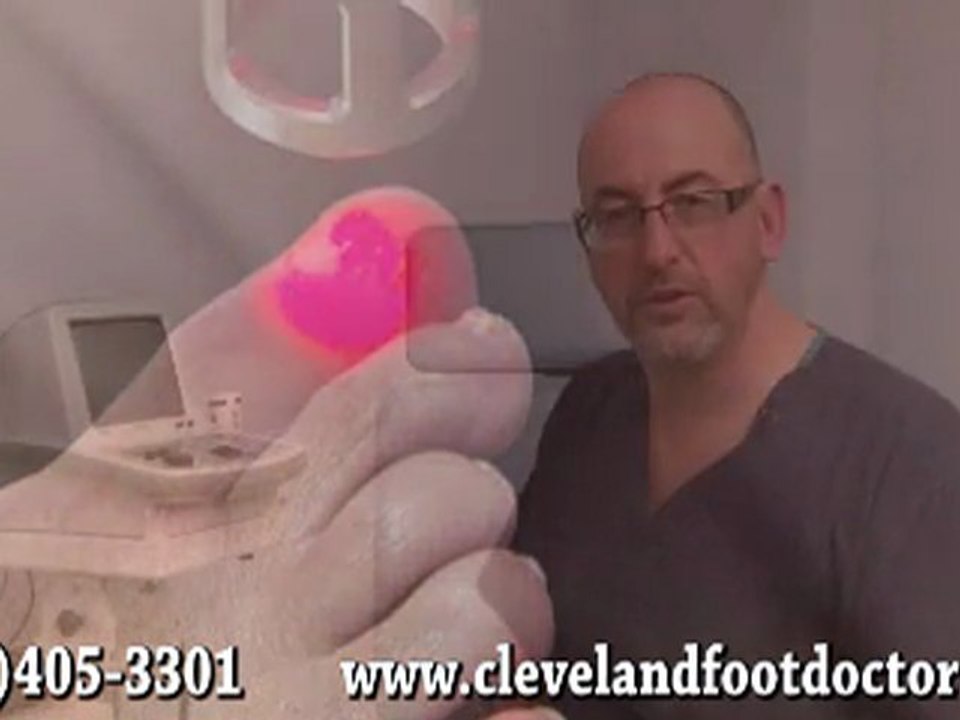 Laser Therapy Ingrown Toenails & Warts - Podiatrist in Twinsburg and Lakewood, OH