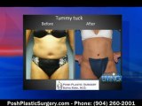 Posh Plastic Surgery on Liposuction and Tummy Tucks