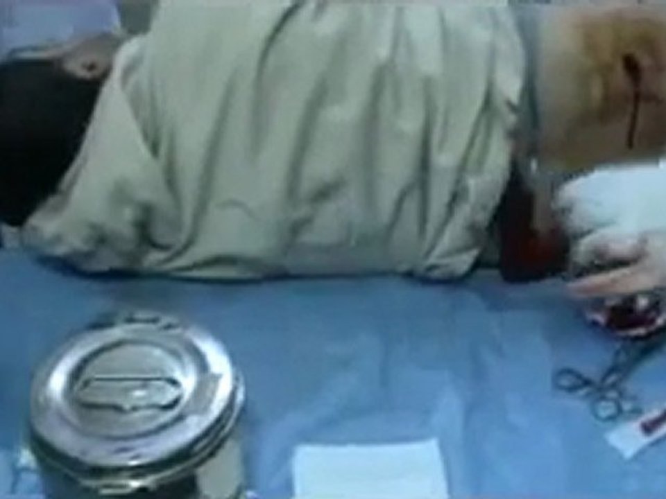 فري برس   حمص باباعمرو جريح في الظهر برصاص قناصة 5 2 2012