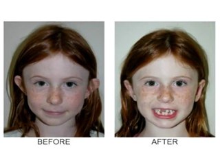 Ear Surgery (Otoplasty) Newport Beach|Dr Michael Sundine