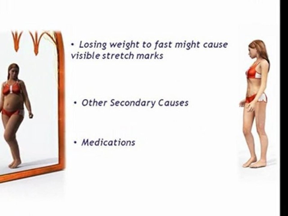 Stretch Marks Removal|Simple tips to Remove Stretch Marks|How Do I Remove Stretch Marks|Stretch-marks|How To Eliminate Stretch Marks|How To Minimize Stretch Marks|Reasons Of Stretch Marks|How Do You Get Stretch Marks}