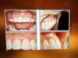 Dental Implants Washington DC