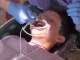 Fort Collins Orthodontist Putting Braces On - See How it is Done (Time Lapse)