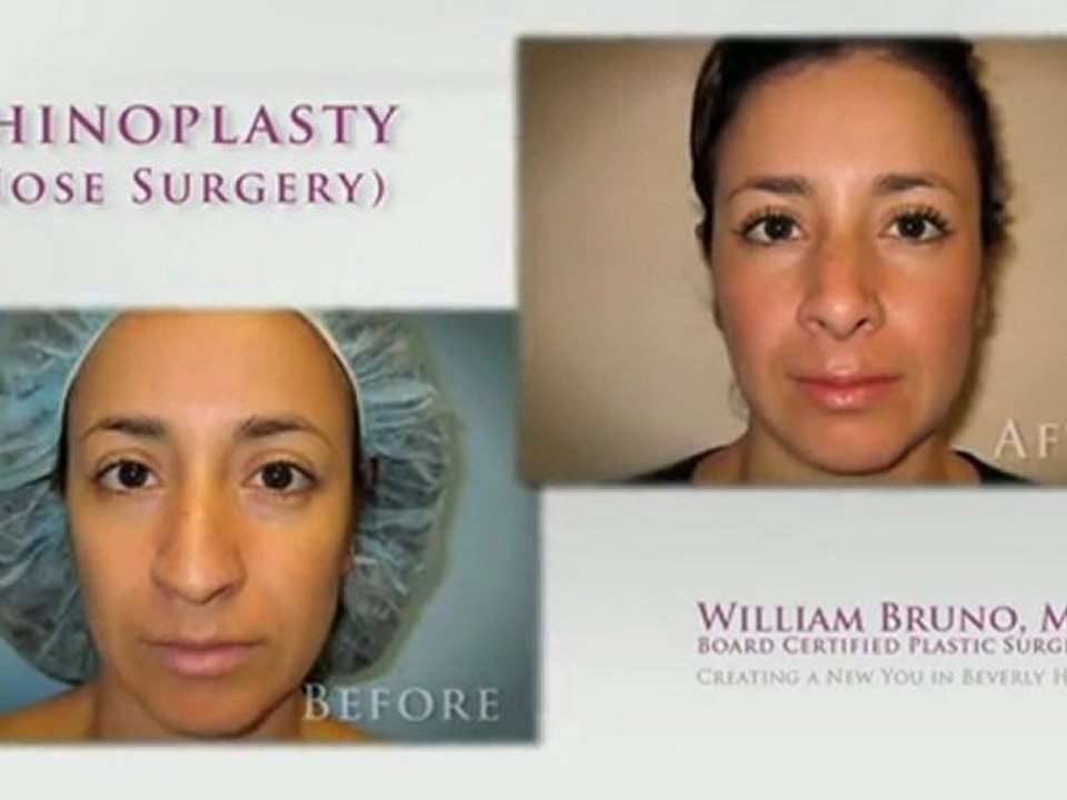 Rhinoplasty Beverly Hills| Dr William Bruno