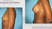 Breast Augmentation Beverly Hills| Dr William Bruno