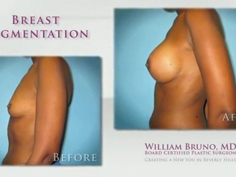 Breast Augmentation Beverly Hills| Dr William Bruno