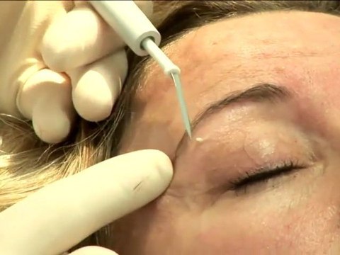 How To Get Rid Of Milia