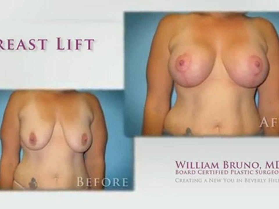 Breast Lift Beverly Hills| Dr William Bruno