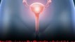 Tratamiento De Ovarios Poliquísticos Síntomas – Curar Quistes De Ovario – Quistes Ováricos