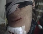 فري برس   حمص حي كرم الزيتون اصابة رجل في بطنه 15 2 2012