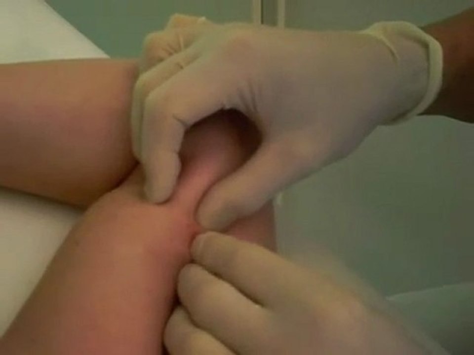 Implant removal