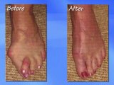 Bunion Surgery - Podiatrist Kansas City, Lee's Summit, MO & Overland Park, KS