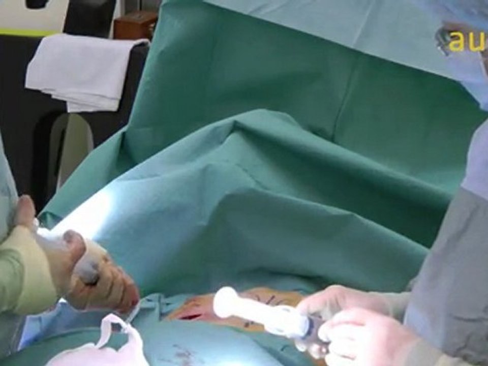PIP Implant replacement surgery and removal of silicone granulomas by Mr Prashant Govilkar from Aurora clinics
