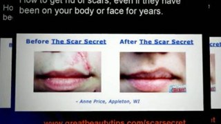 How to get rid of scars - remove scars naturally. How to cure scar naturally.