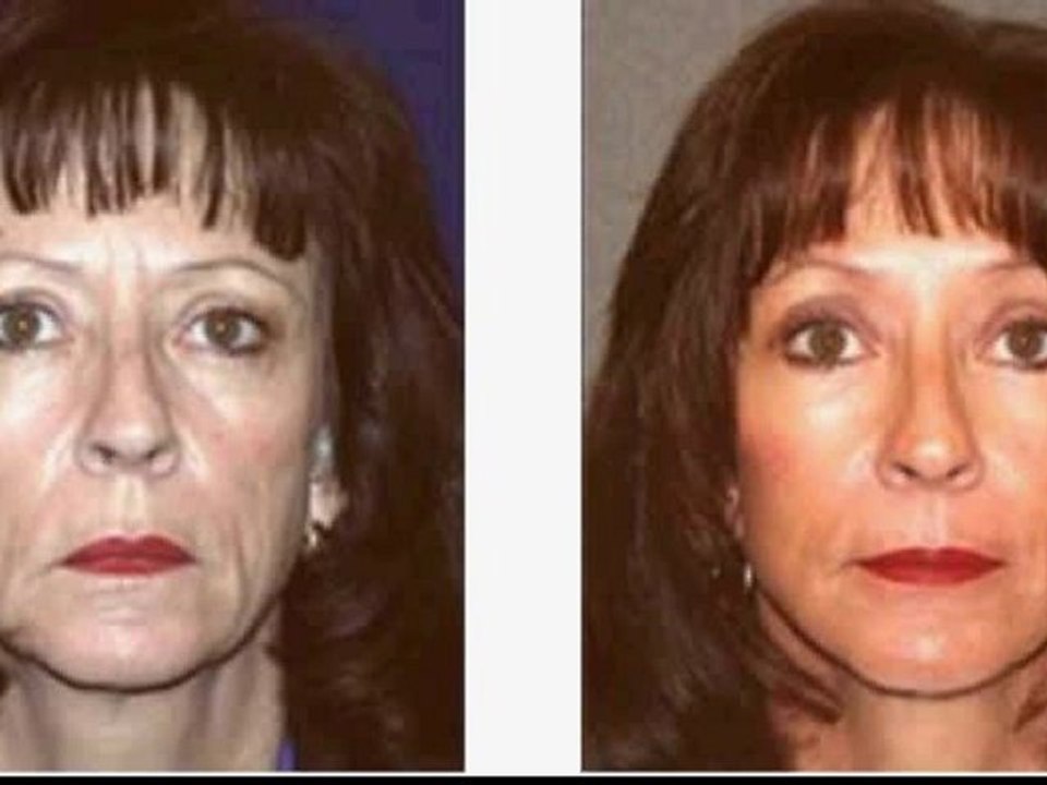 Result images after a facelift