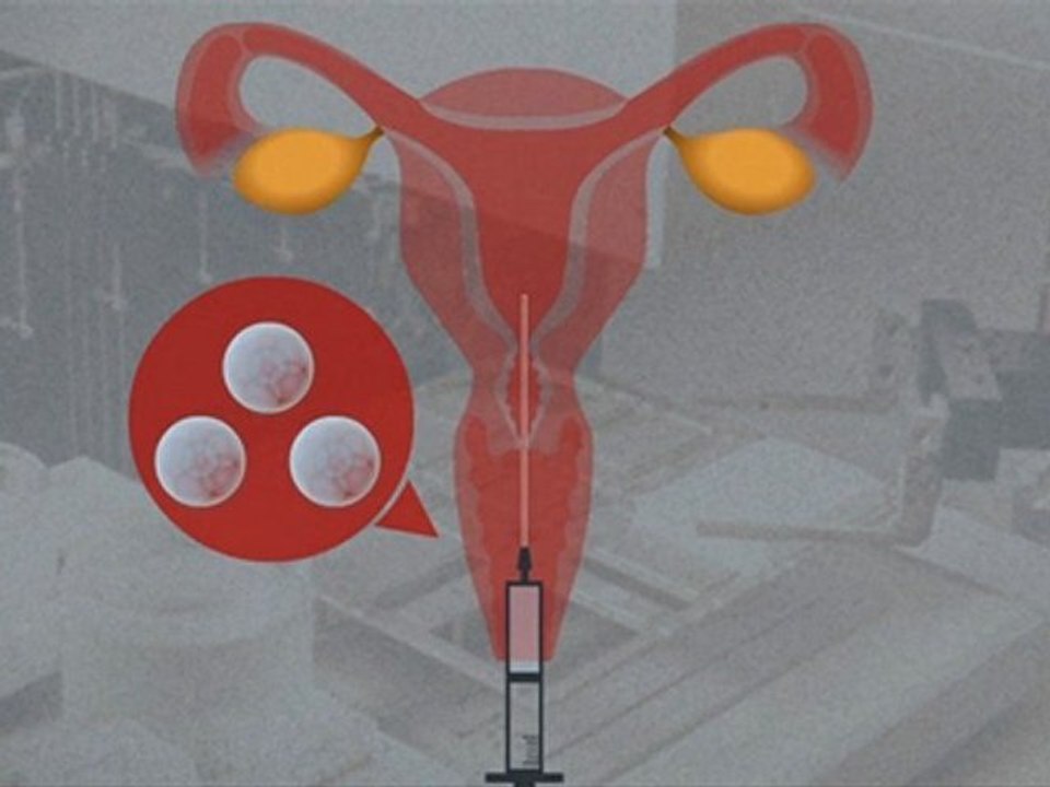 La fécondation in vitro