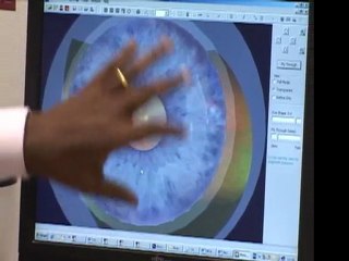 Charles Babumba about Optomap (retinal scanner) on SBT TV (Brazil)