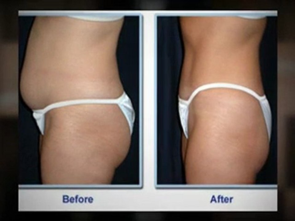Laser Liposuction - Is it Right for You?