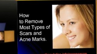 How to cure acne fast at home - Natural ways to clear acne fast