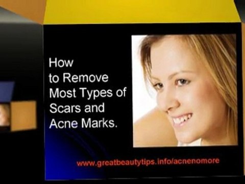 How to cure acne fast at home - Natural ways to clear acne fast