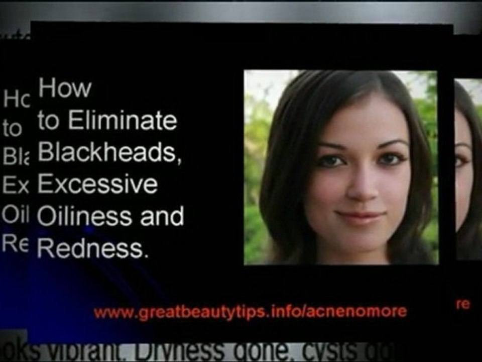 Acne treatment at home - Natural treatment for acne and pimples