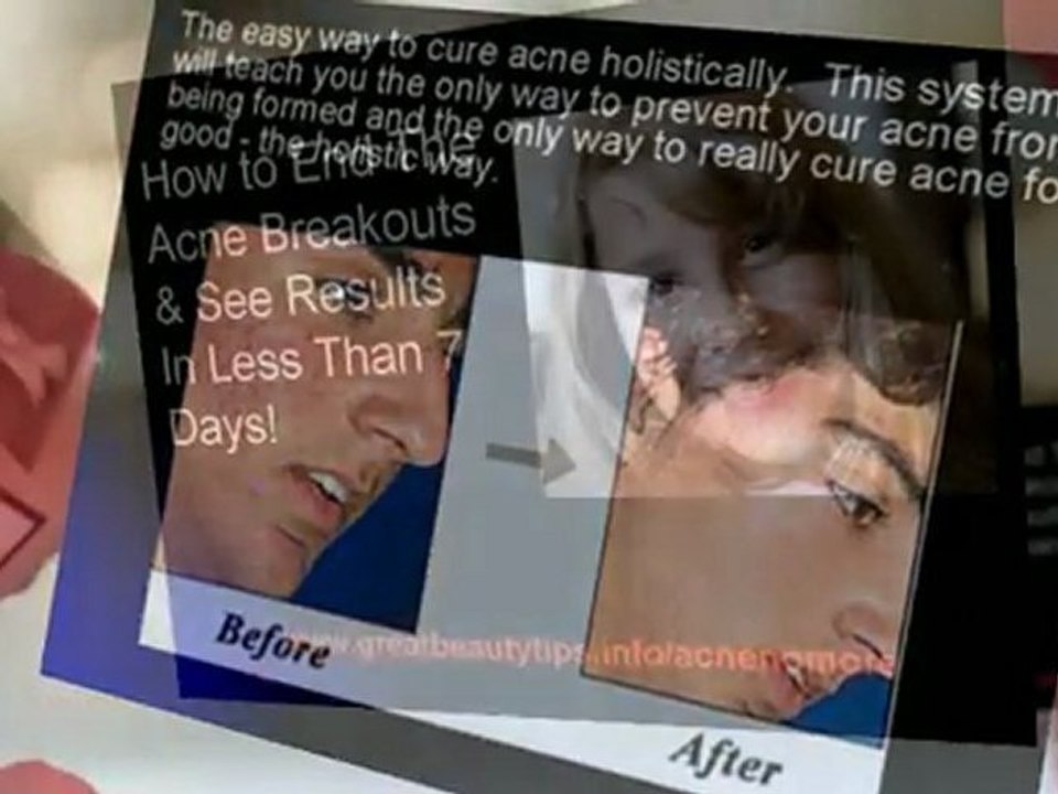 How to get rid of acne fast at home. How to get rid of acne naturally.