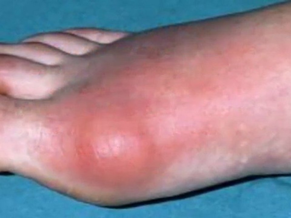 How To Get Rid of Gout Pain at Home - gout pain relief home remedies