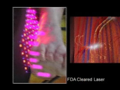 Peripheral Neuropathy Relief - Atlanta, GA