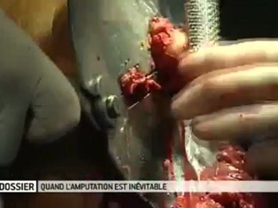 Quand l'amputation s'impose...   Allodocteurs