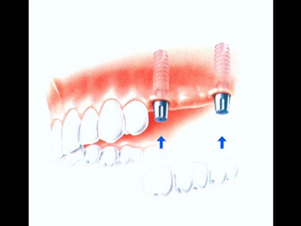 Crowns | Bridges | Dental | Abroad