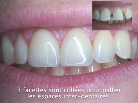 Facettes dentaires et espaces
