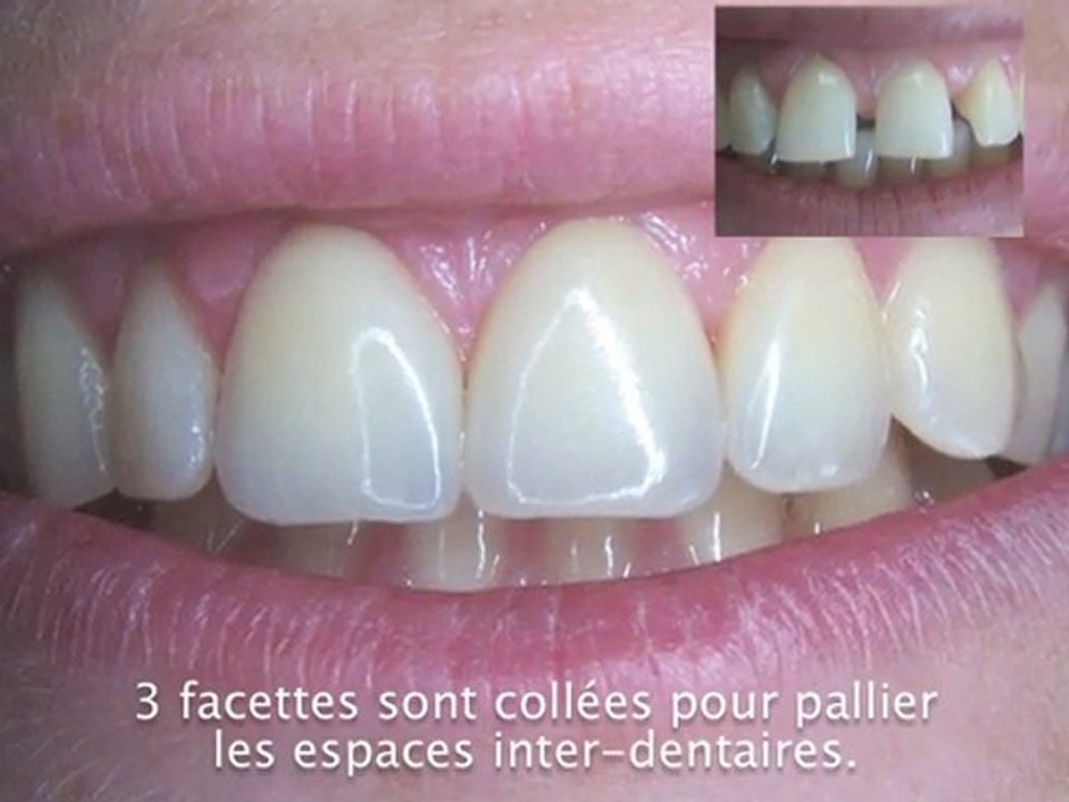Facettes dentaires et espaces