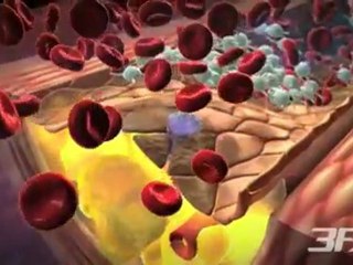 Diabetes-Related Atherosclerosis