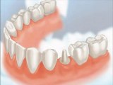 Dental Crowns Gurnee IL - Tooth Crowns Gurnee IL - Gurnee IL Porcelain Crowns