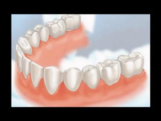 Dental Crowns Lake Bluff IL - Tooth Crowns Lake Bluff IL - Lake Bluff IL Porcelain Crowns