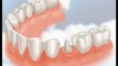 Dental Crowns Lake County IL - Tooth Crowns Lake County IL - Lake County IL Porcelain Crowns