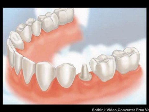 Dental Crowns Lake County IL - Tooth Crowns Lake County IL - Lake County IL Porcelain Crowns