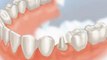 Dental Crowns Round Lake Beach IL - Tooth Crowns Round Lake Beach IL - Round Lake Beach IL Porcelain Crowns