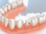 Dental Crowns Vernon Hills IL - Tooth Crowns Vernon Hills IL - Vernon Hills IL Porcelain Crowns