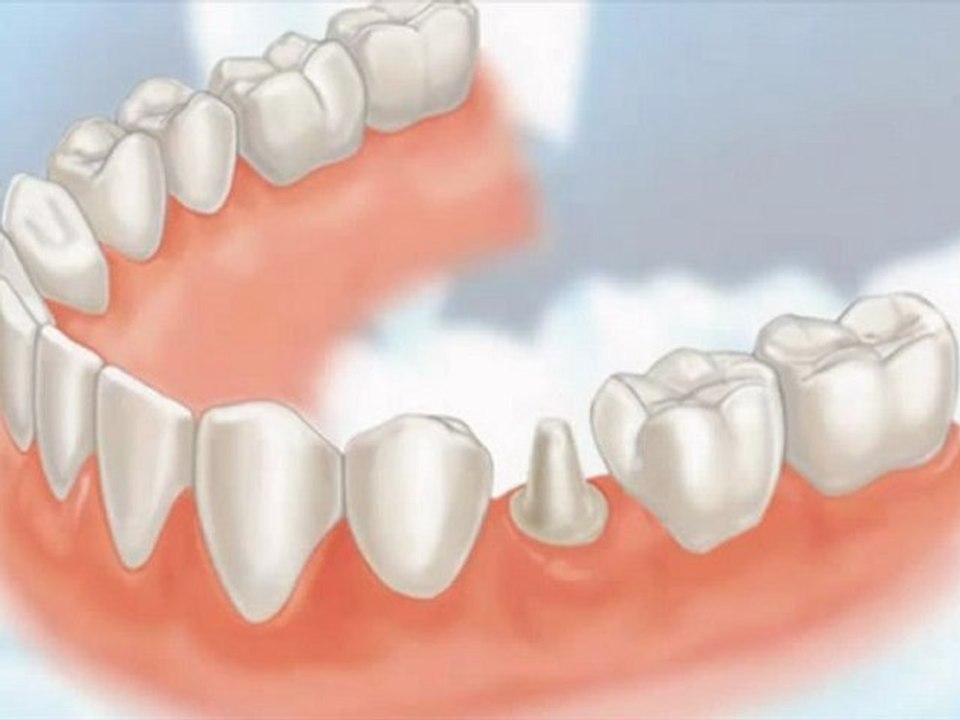 Zion IL Crowns Dental