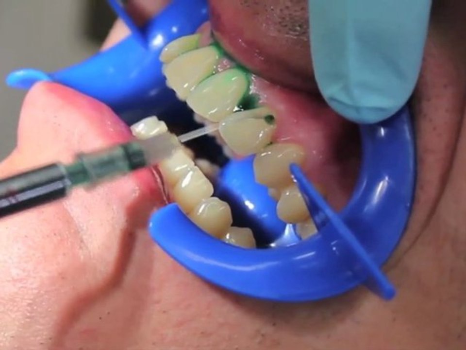 Emundo: Die schmerzfreie Parodontitis Behandlung