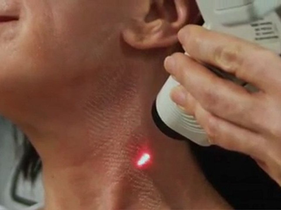 DermFx Deepfx Procedure Learn More About DermFx Deepfx Procedure Call: 562-592-5100
