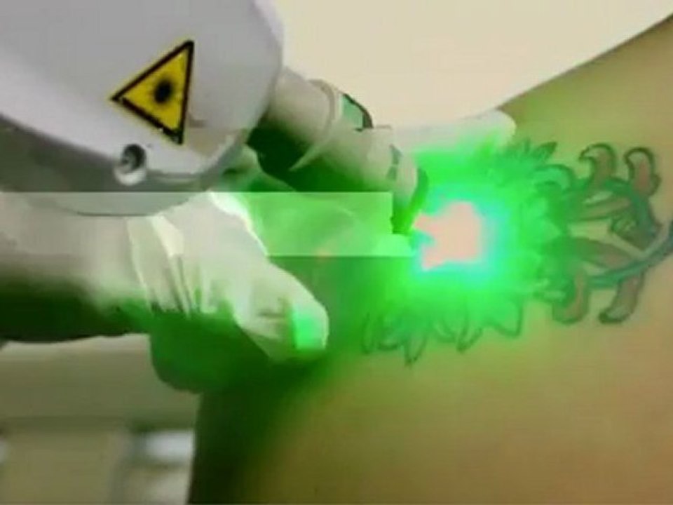 DermFx Tattoo Removal Get Your Tattoo Removal Call 562-592-5100