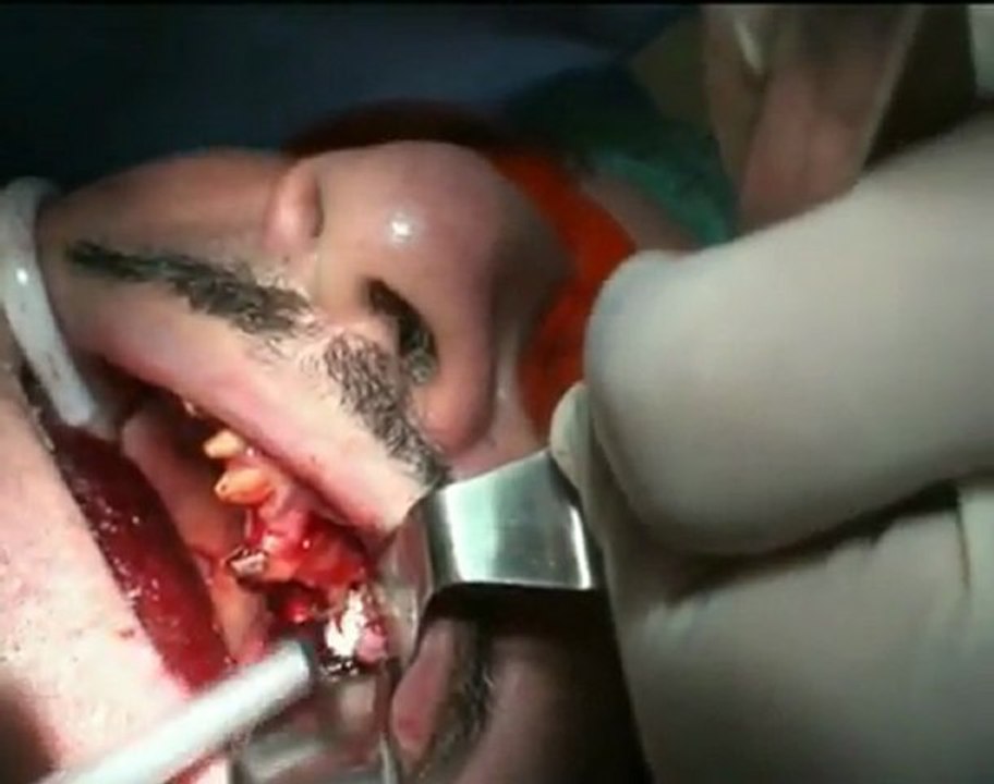easy graft external синус лифтинг.avi