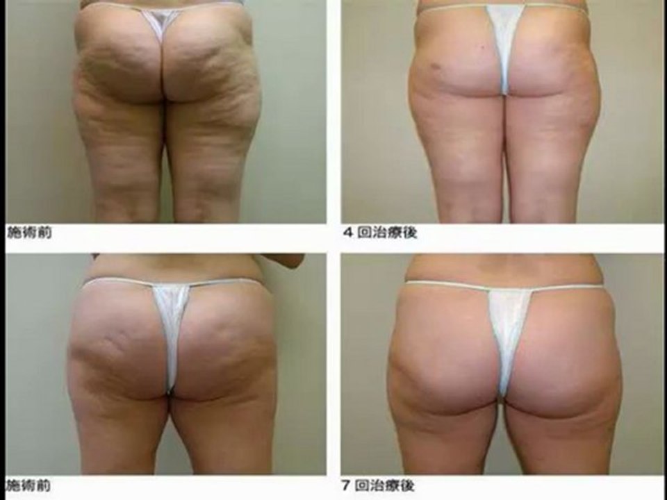 Combattere Cellulite--[Dieta Dimagrante Anticellulite]