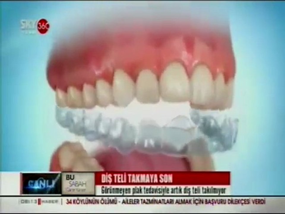 İlke Elgün Sky Turk 360 Diş Teli Takmaya Son