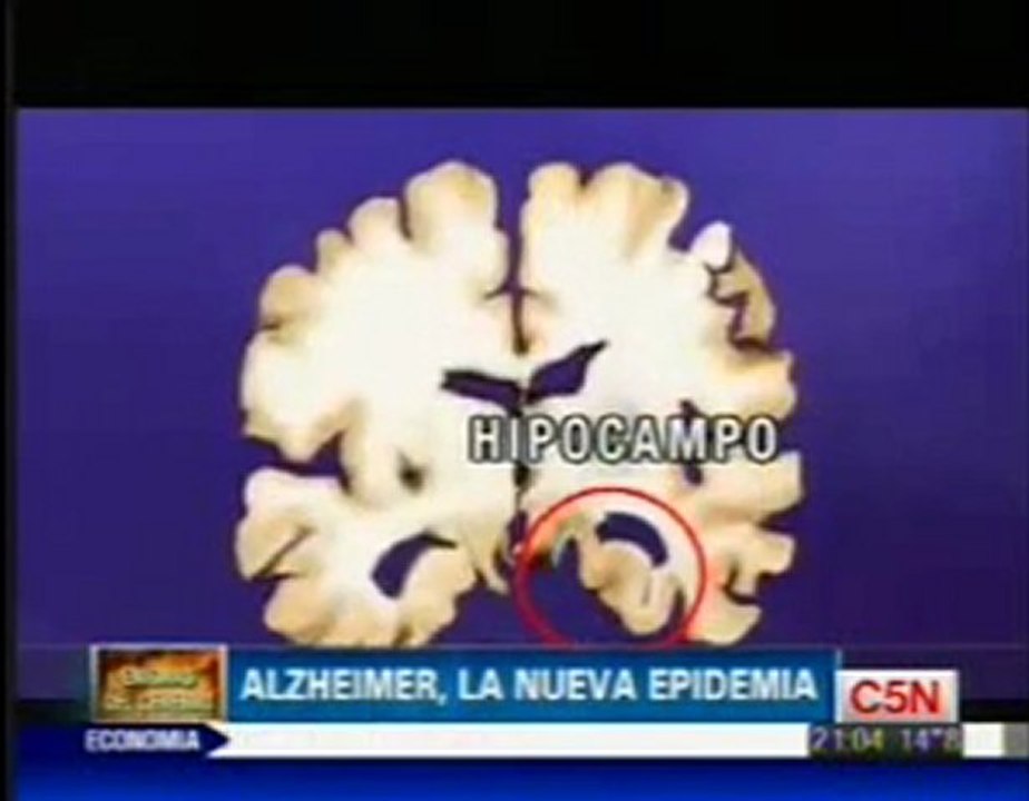 Alzheimer: Epidemia global (Facundo Manes)