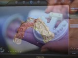 Digital Scan Benefits Over Impressions - Winnipeg Dentist