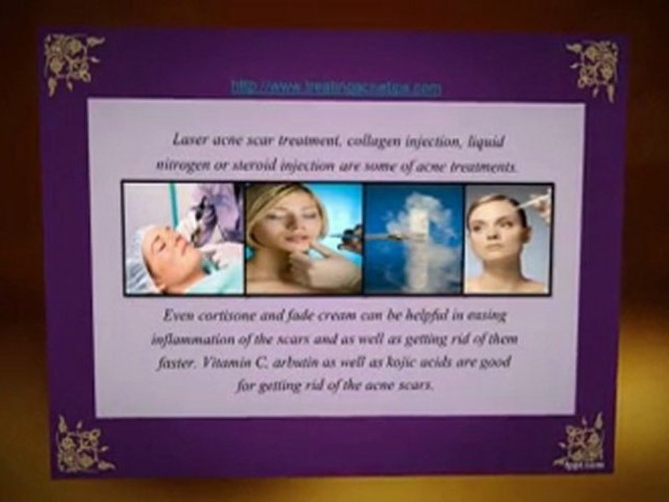 Treating Acne Scars