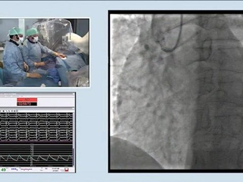 06 right coronary cto recanalization by antegrade approach incathlab.com